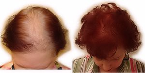 female hair loss before after