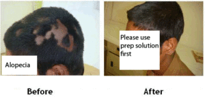 alopecia with prep