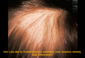 trichotillomania